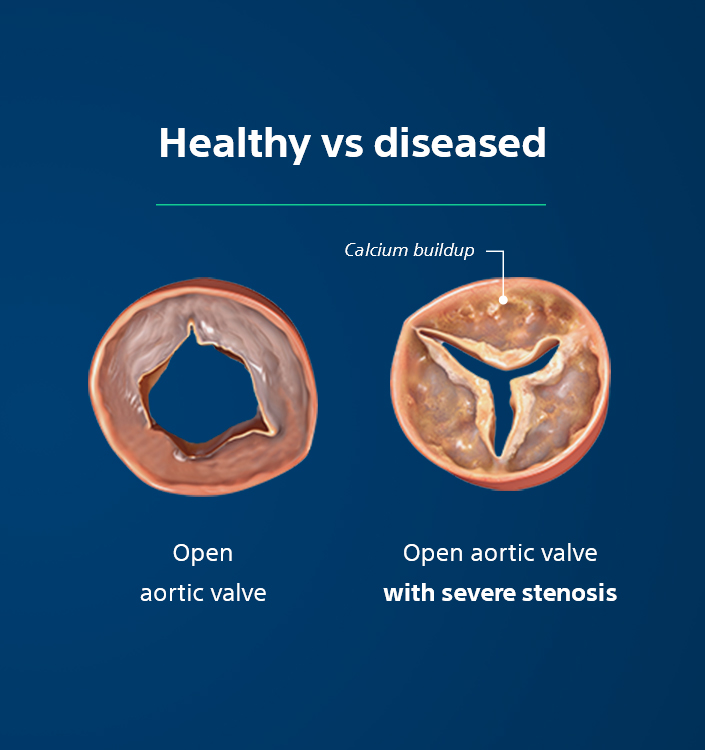 Healthy vs diseased