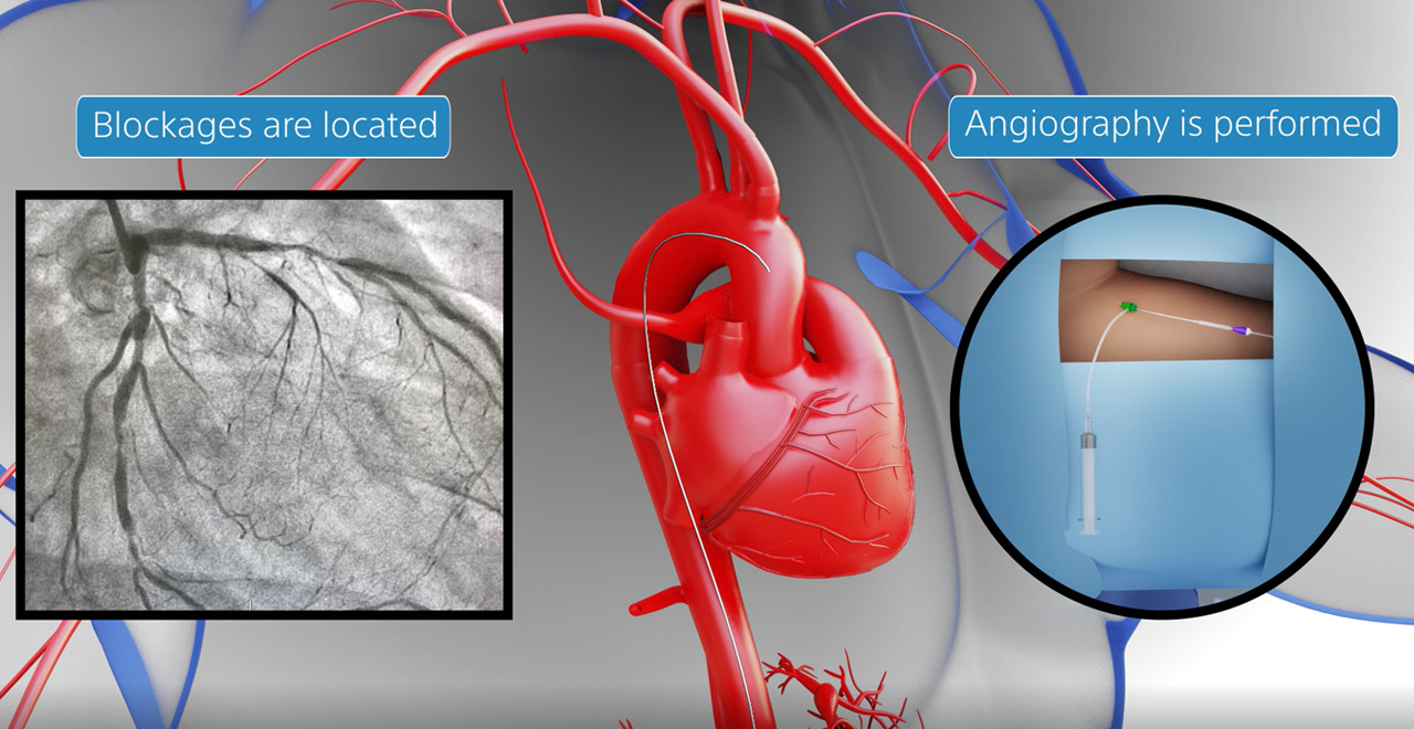 Watch the video below to know how coronary stents work