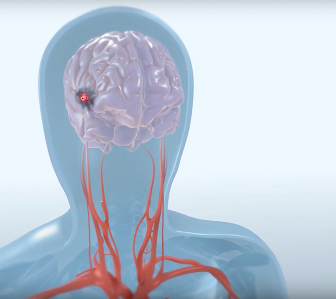 Cerebral embolic protoction