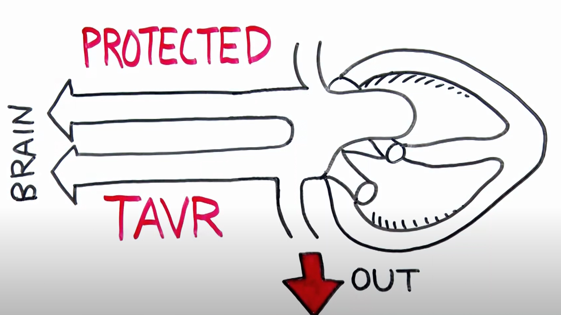 Why is Protected TAVR impor