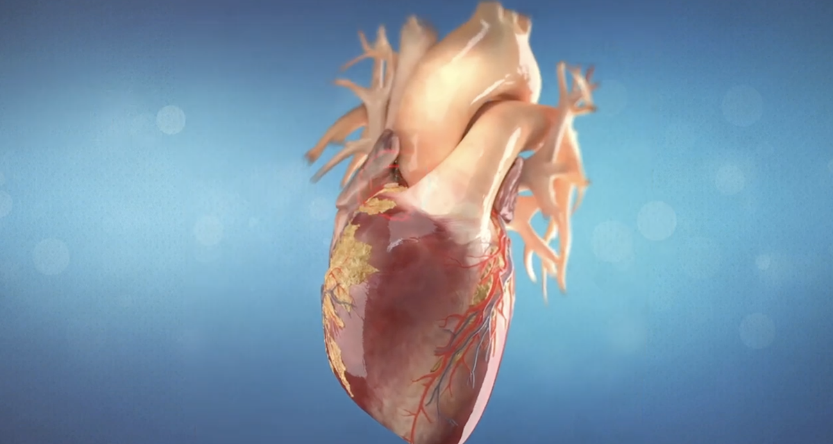 The Rotational Atherectomy Procedure